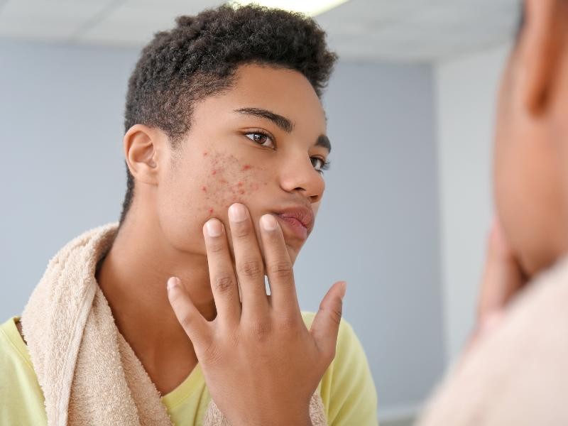 Meu Filho é Adolescente e tem Muita Acne, Como Posso Tratá-la?